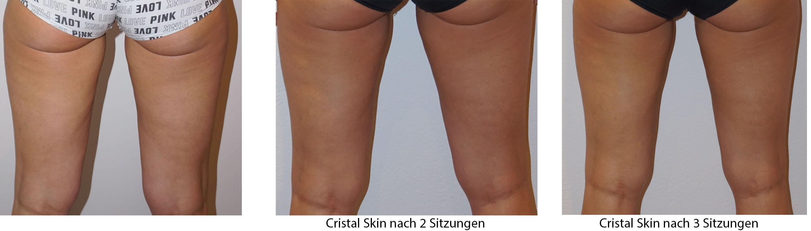 Cristal Skin - Radiofrequenz als Alternative