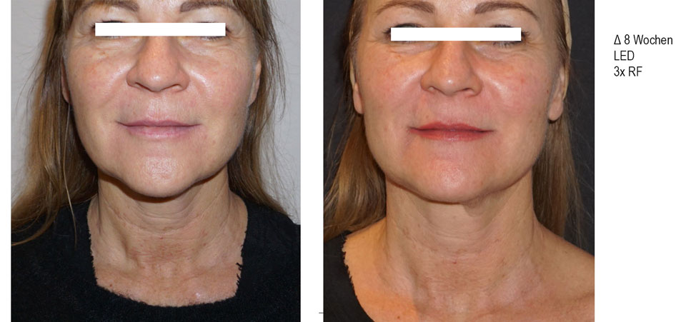 Cristal Skin - Radiofrequenz als Alternative