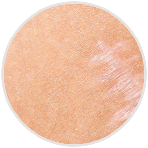 Narben und Dehnungsstreifen